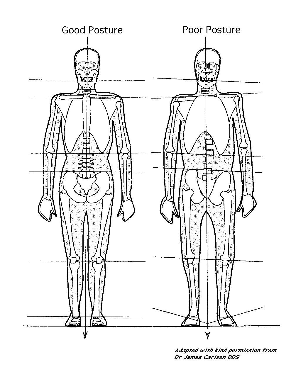 Front Posture Analysis